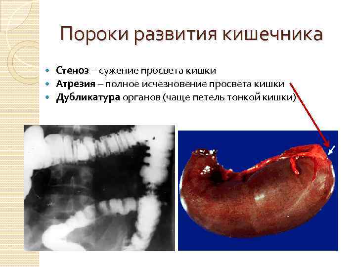 Пороки развития кишечника Стеноз – сужение просвета кишки Атрезия – полное исчезновение просвета кишки