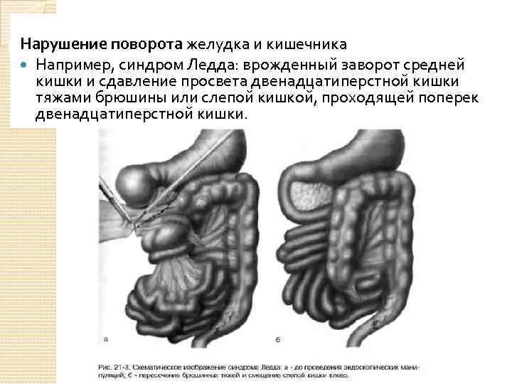 Нарушение поворота желудка и кишечника Например, синдром Ледда: врожденный заворот средней кишки и сдавление