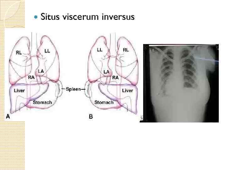  Situs viscerum inversus 