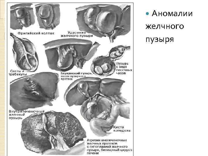 Аномалии желчного пузыря 