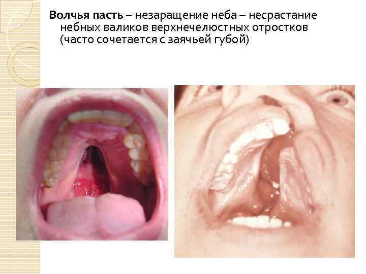 Волчья пасть – незаращение неба – несрастание небных валиков верхнечелюстных отростков (часто сочетается с