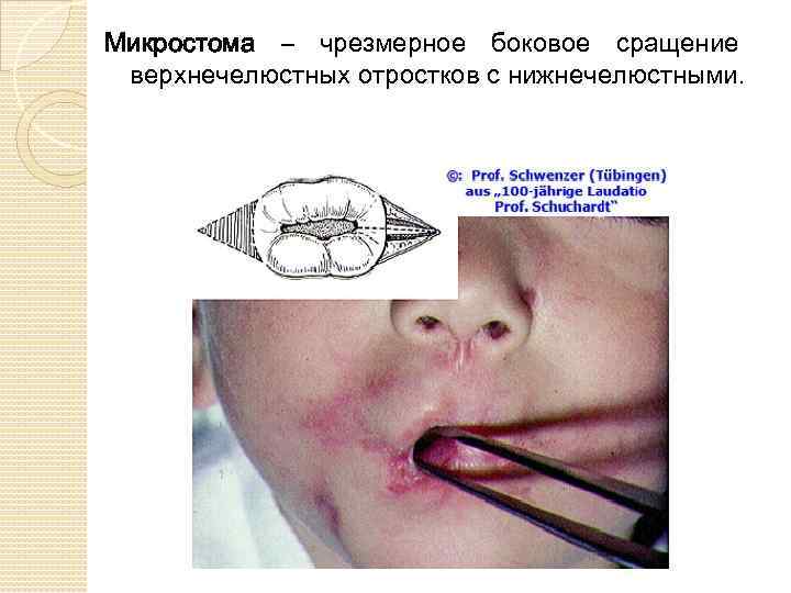 Микростома – чрезмерное боковое сращение верхнечелюстных отростков с нижнечелюстными. 