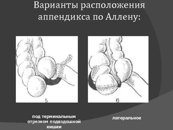 Варианты расположения аппендикса по Аллену: под терминальным отрезком подвздошной кишки латеральное 