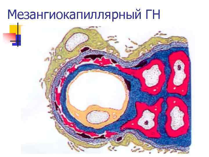 Мезангиокапиллярный ГН 