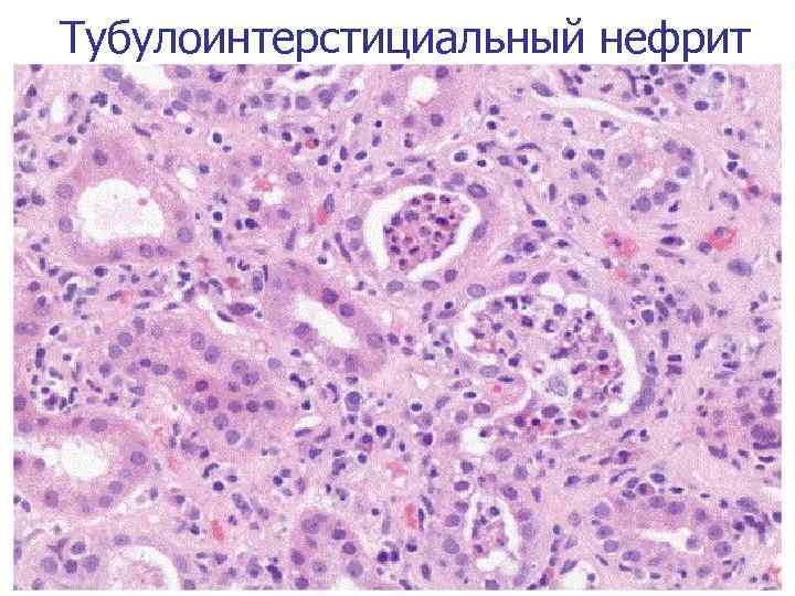 Тубулоинтерстициальный нефрит 