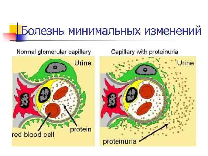 Болезнь минимальных изменений 