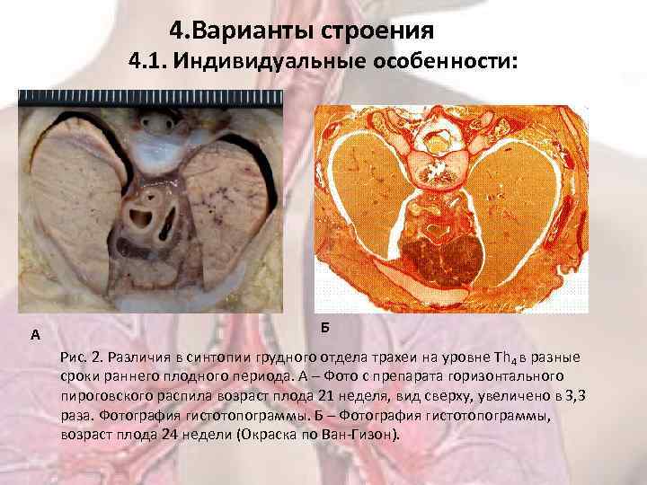 4. Варианты строения 4. 1. Индивидуальные особенности: А Б Рис. 2. Различия в синтопии