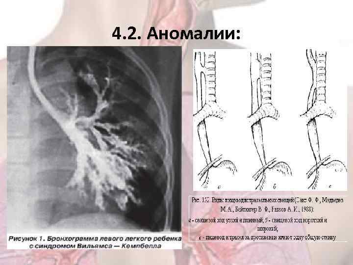 4. 2. Аномалии: 