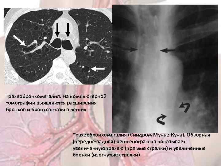 Трахеобронхомегалия. На компьютерной томографии выявляются расширения бронхов и бронхоэктазы в легких Трахеобронхомегалия (Синдром Мунье-Куна).