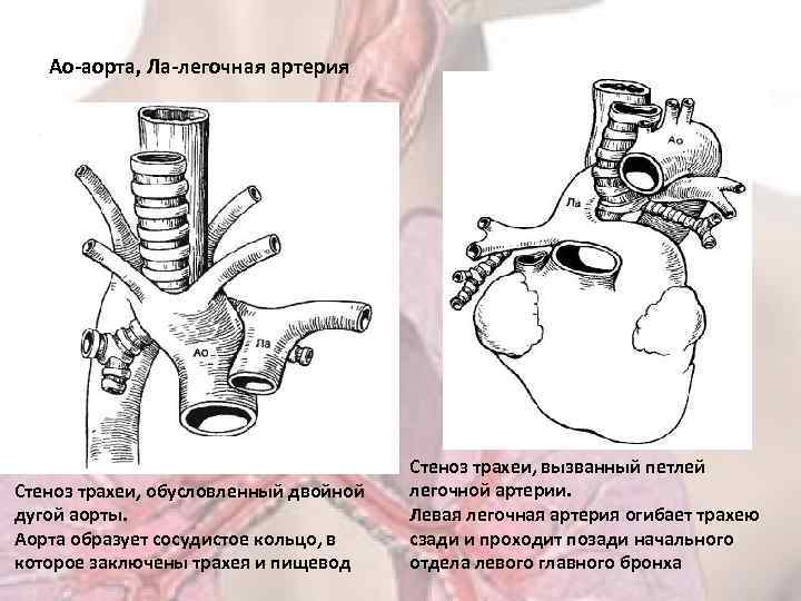 Ао-аорта, Ла-легочная артерия Стеноз трахеи, обусловленный двойной дугой аорты. Аорта образует сосудистое кольцо, в