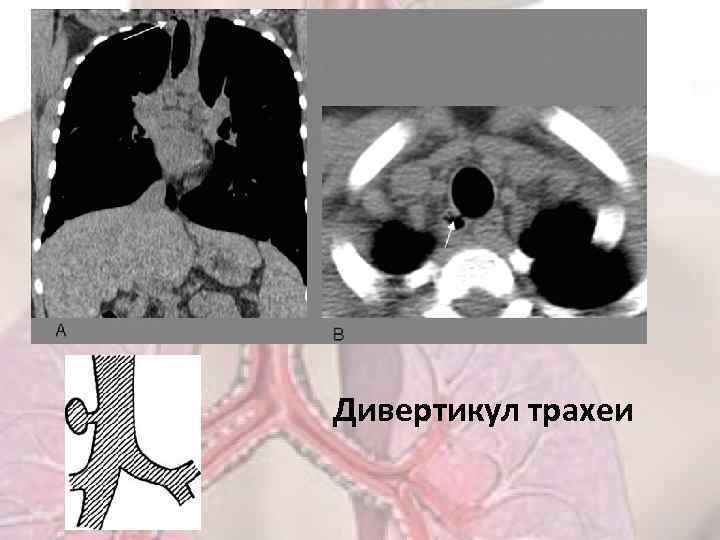 Дивертикул трахеи 