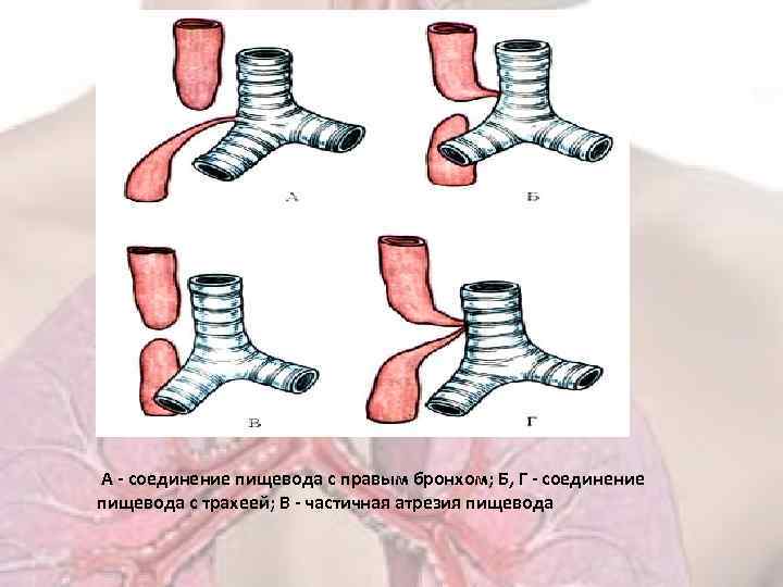  А - соединение пищевода с правым бронхом; Б, Г - соединение пищевода с