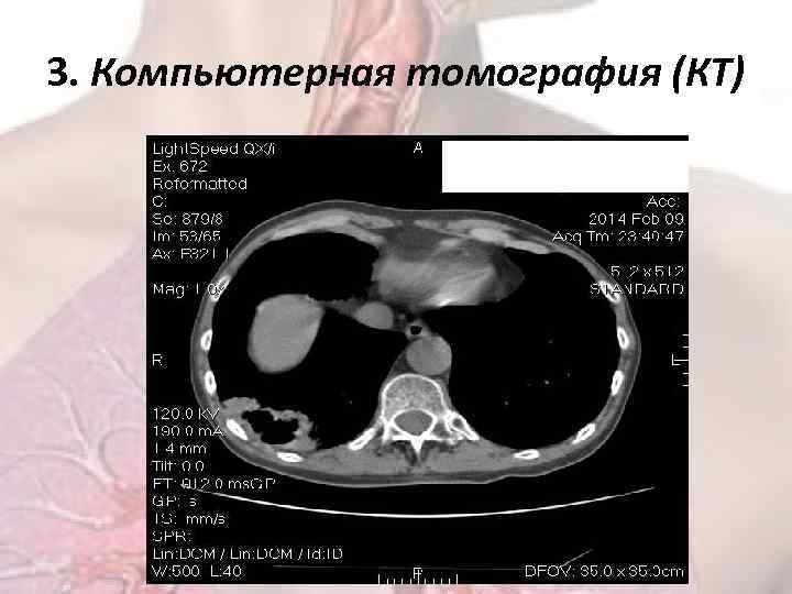 3. Компьютерная томография (КТ) 