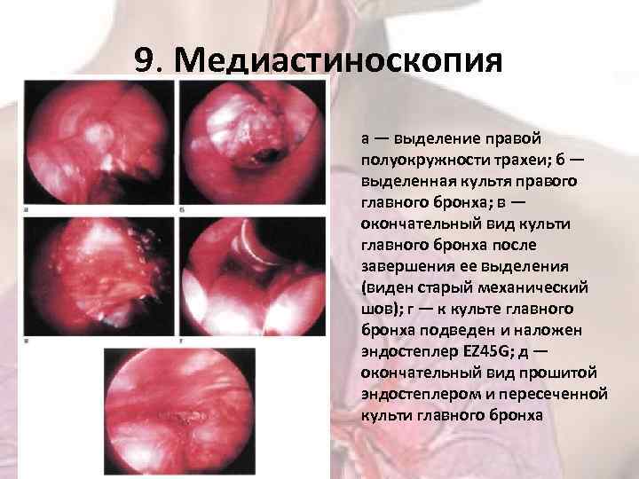 9. Медиастиноскопия а — выделение правой полуокружности трахеи; б — выделенная культя правого главного