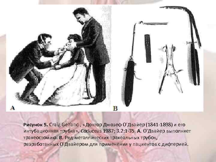 Рисунок 5. Craig Gelfand , «Доктор Джозеф О'Двайер (1841 -1898) и его интубационная трубка»