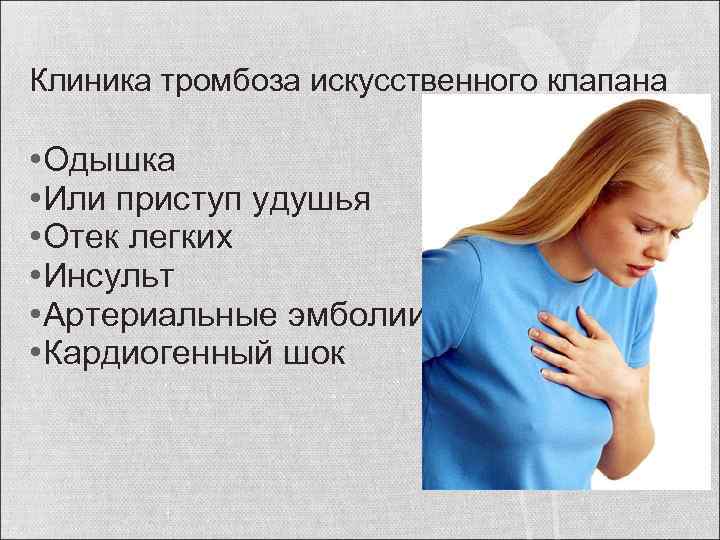 Клиника тромбоза искусственного клапана • Одышка • Или приступ удушья • Отек легких •