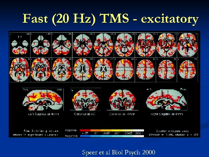 Fast (20 Hz) TMS - excitatory Speer et al Biol Psych 2000 