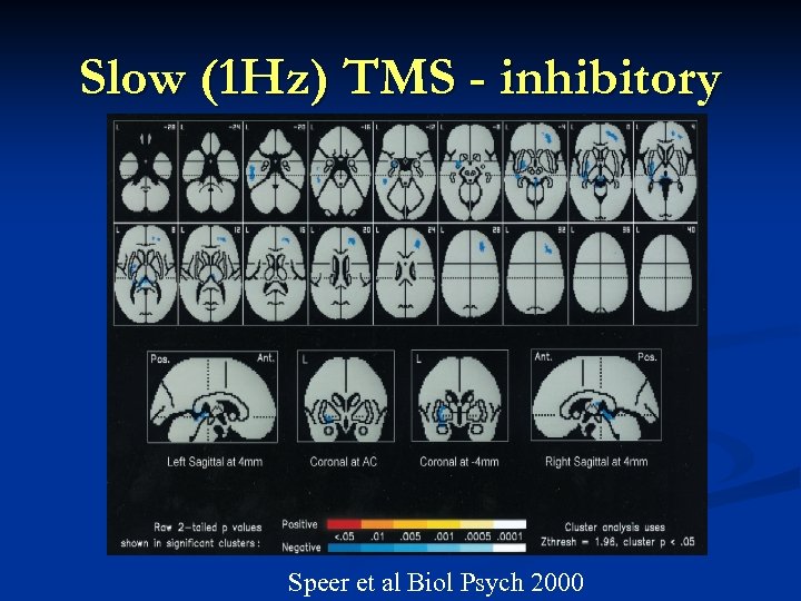 Slow (1 Hz) TMS - inhibitory Speer et al Biol Psych 2000 