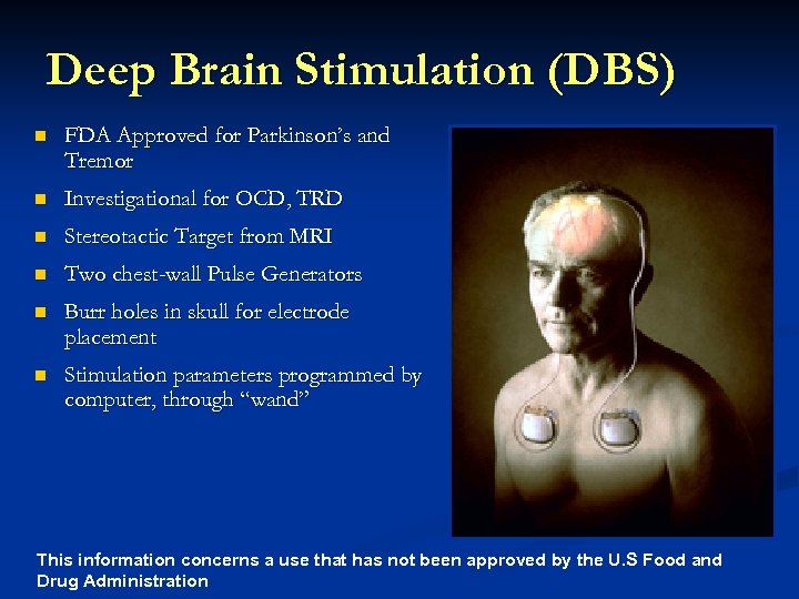 Deep Brain Stimulation (DBS) n FDA Approved for Parkinson’s and Tremor n Investigational for