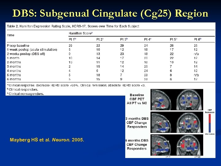 DBS: Subgenual Cingulate (Cg 25) Region Response in 4 of 6 patients Response associated