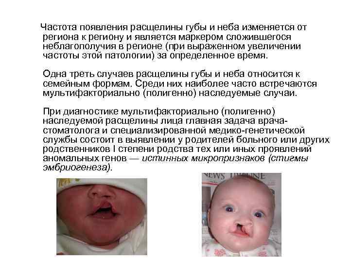  Частота появления расщелины губы и неба изменяется от региона к региону и является
