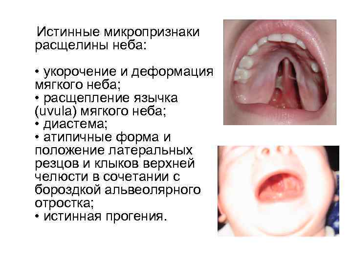  Истинные микропризнаки расщелины неба: • укорочение и деформация мягкого неба; • расщепление язычка