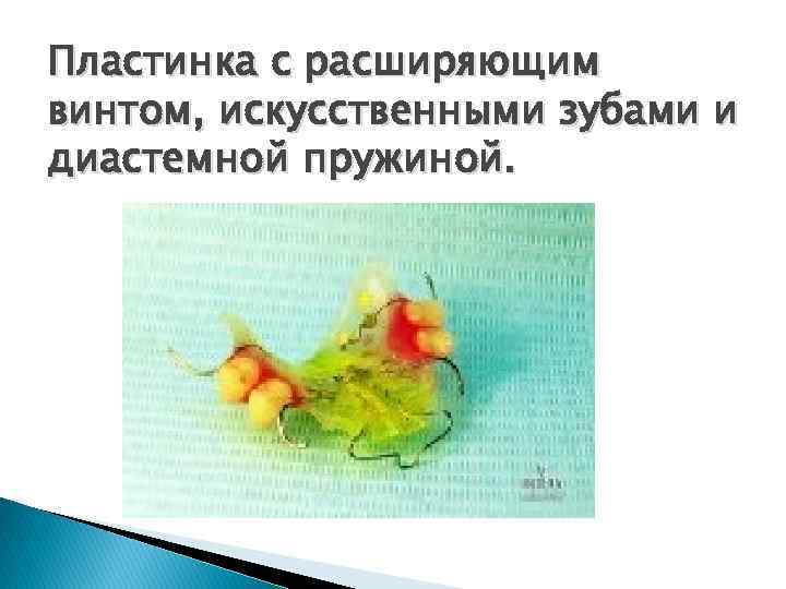 Пластинка с расширяющим винтом, искусственными зубами и диастемной пружиной. 