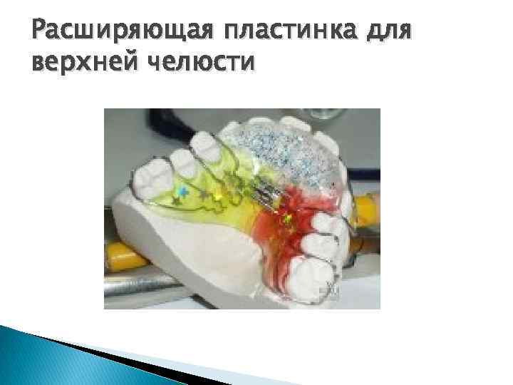 Расширяющая пластинка для верхней челюсти 