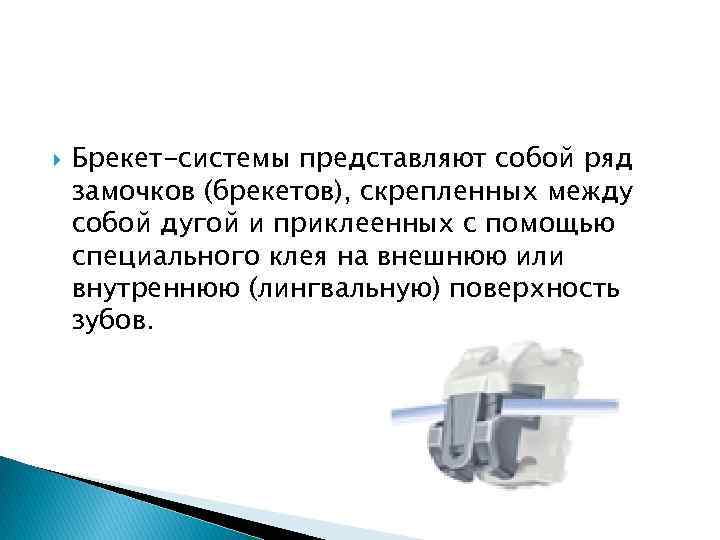  Брекет-системы представляют собой ряд замочков (брекетов), скрепленных между собой дугой и приклеенных с