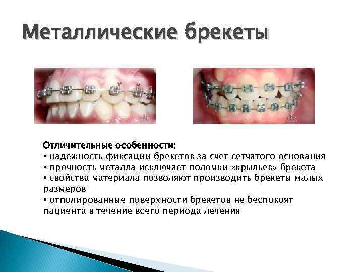 Металлические брекеты Отличительные особенности: • надежность фиксации брекетов за счет сетчатого основания • прочность