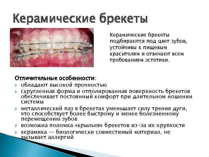 Керамические брекеты подбираются под цвет зубов, устойчивы к пищевым красителям и отвечают всем требованиям
