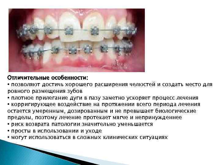 Отличительные особенности: • позволяют достичь хорошего расширения челюстей и создать место для ровного размещения