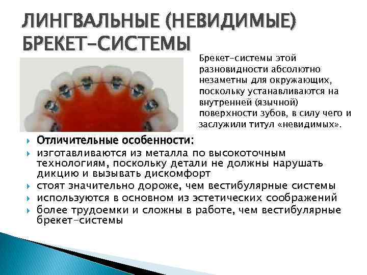 ЛИНГВАЛЬНЫЕ (НЕВИДИМЫЕ) БРЕКЕТ-СИСТЕМЫ Брекет-системы этой разновидности абсолютно незаметны для окружающих, поскольку устанавливаются на внутренней