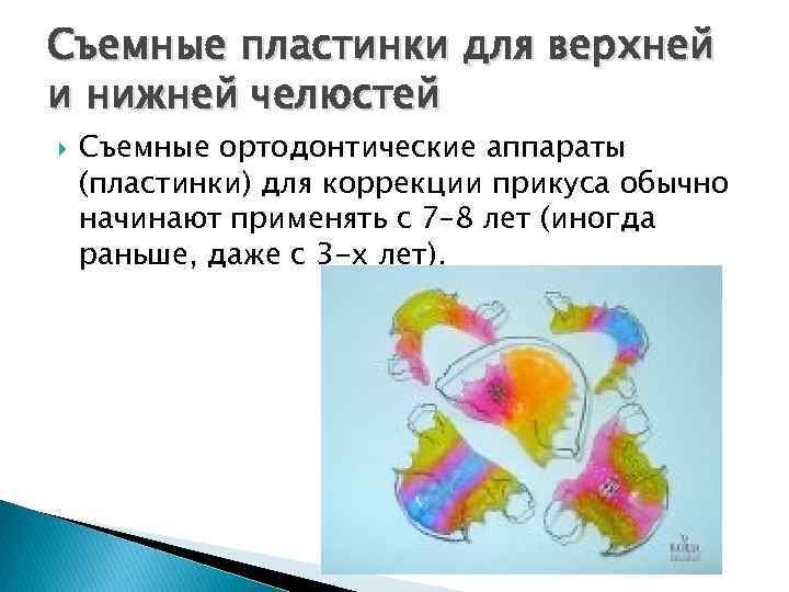 Съемные пластинки для верхней и нижней челюстей Съемные ортодонтические аппараты (пластинки) для коррекции прикуса