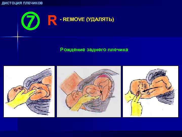 ДИСТОЦИЯ ПЛЕЧИКОВ R - REMOVE (УДАЛЯТЬ) Рождение заднего плечика 