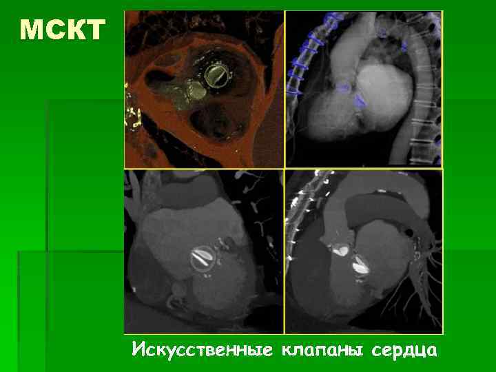 МСКТ Искусственные клапаны сердца 