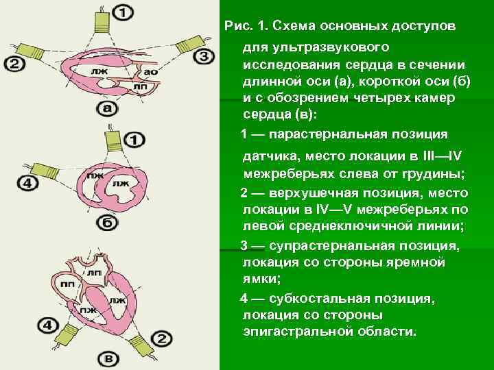 Рис. 1. Схема основных доступов для ультразвукового исследования сердца в сечении длинной оси (а),