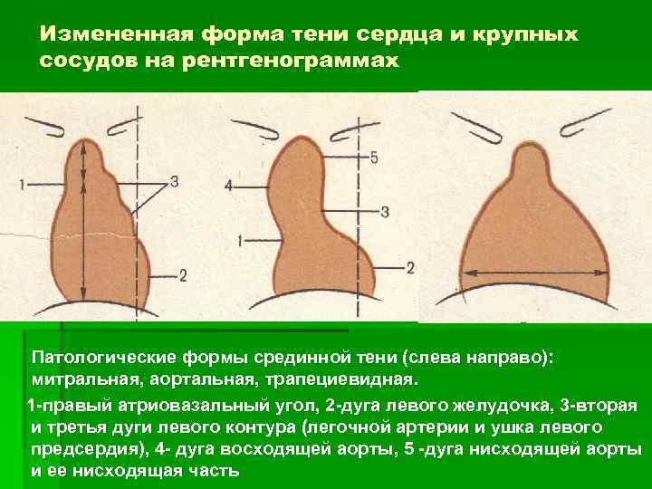 Измененная форма тени сердца и крупных сосудов на рентгенограммах Патологические формы срединной тени (слева