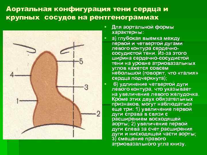 Аортальная конфигурация тени сердца и крупных сосудов на рентгенограммах § Для аортальной формы характерны: