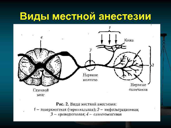 Виды местной анестезии 