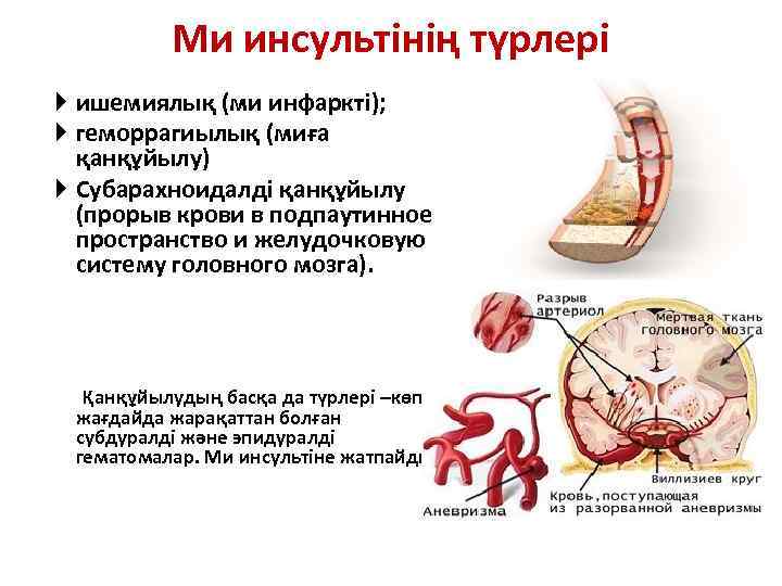 Ми инсультінің түрлері Выделяют три основных типа МИ: ишемиялық (ми инфаркті); геморрагиылық (миға қанқұйылу)