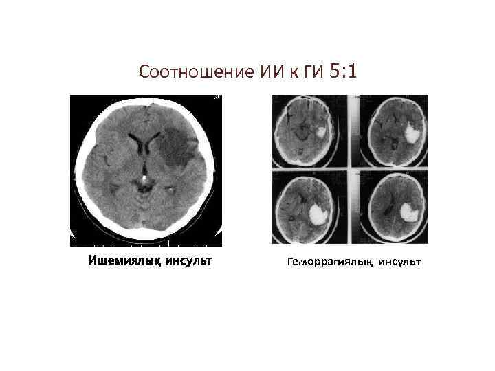 Соотношение ИИ к ГИ 5: 1 Ишемиялық инсульт Геморрагиялық инсульт 