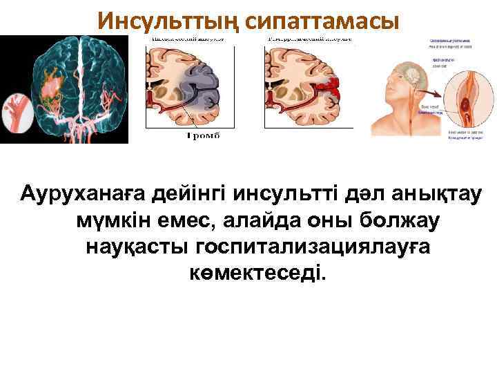 Инсульттың сипаттамасы Ауруханаға дейінгі инсультті дәл анықтау мүмкін емес, алайда оны болжау науқасты госпитализациялауға