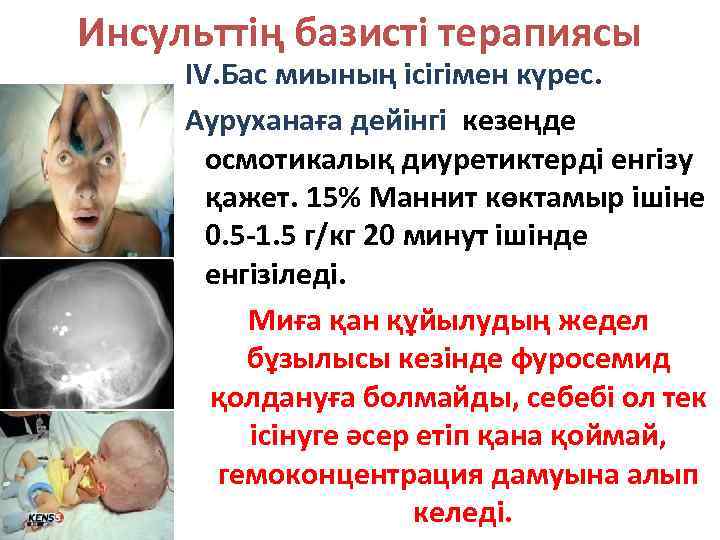 Инсульттің базисті терапиясы IV. Бас миының ісігімен күрес. Ауруханаға дейінгі кезеңде осмотикалық диуретиктерді енгізу