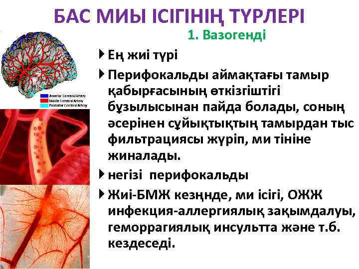 БАС МИЫ ІСІГІНІҢ ТҮРЛЕРІ 1. Вазогенді Ең жиі түрі Перифокальды аймақтағы тамыр қабырғасының өткізгіштігі