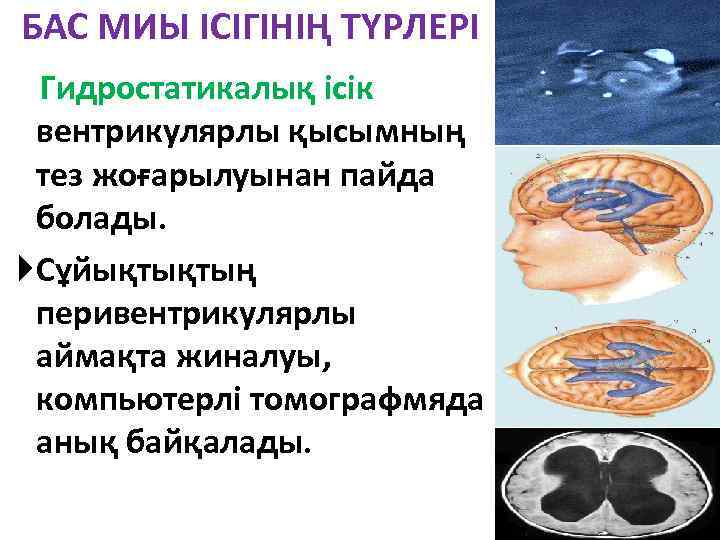 БАС МИЫ ІСІГІНІҢ ТҮРЛЕРІ Гидростатикалық ісік вентрикулярлы қысымның тез жоғарылуынан пайда болады. Сұйықтықтың перивентрикулярлы