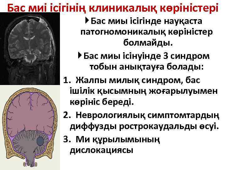 Бас миі ісігінің клиникалық көріністері Бас миы ісігінде науқаста патогномоникалық көріністер болмайды. Бас миы