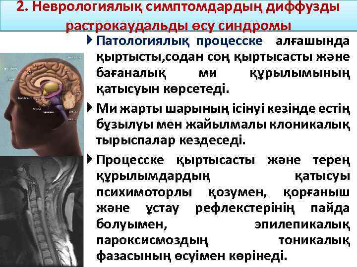 2. Неврологиялық симптомдардың диффузды растрокаудальды өсу синдромы Патологиялық процесске алғашында қыртысты, содан соң қыртысасты