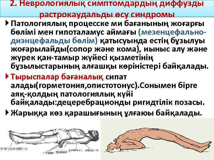 2. Неврологиялық симптомдардың диффузды растрокаудальды өсу синдромы Патологиялық процесске ми бағанының жоғарғы бөлімі мен