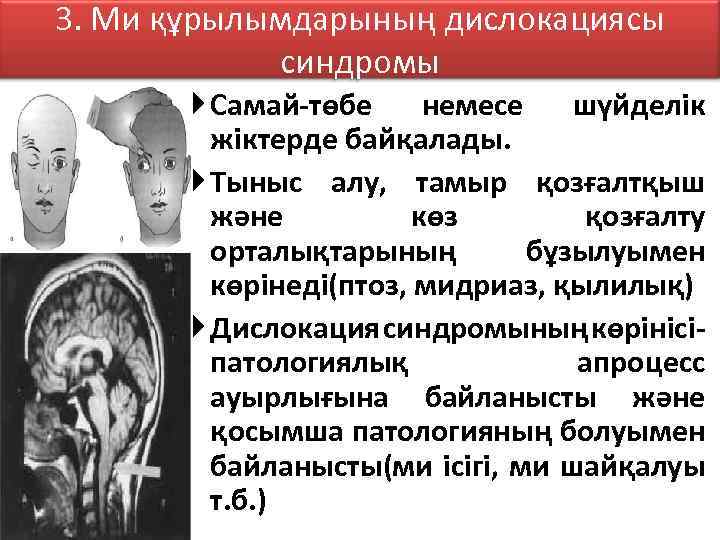 3. Ми құрылымдарының дислокациясы синдромы Самай-төбе немесе шүйделік жіктерде байқалады. Тыныс алу, тамыр қозғалтқыш